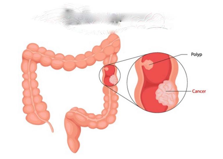 ስለ አንጀት ካንሰር ምን ያህል ያውቃሉ?
