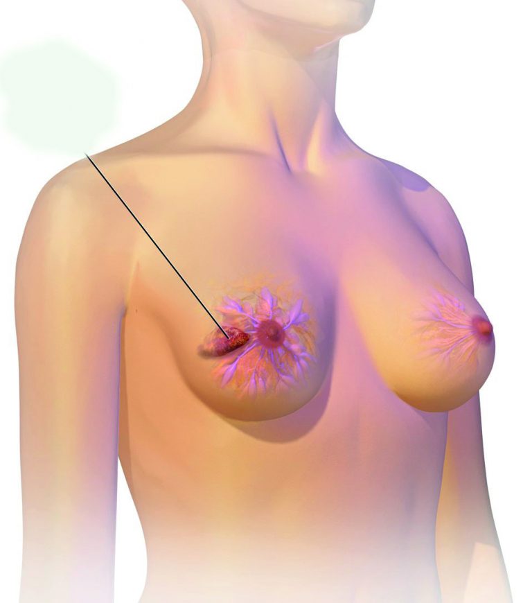 የጡት ካንሠር  ምንነት እና መከላከያዉ